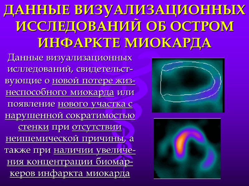 ДАННЫЕ ВИЗУАЛИЗАЦИОННЫХ ИССЛЕДОВАНИЙ ОБ ОСТРОМ ИНФАРКТЕ МИОКАРДА Данные визуализационных ислледований, свидетельст-вующие о новой потере